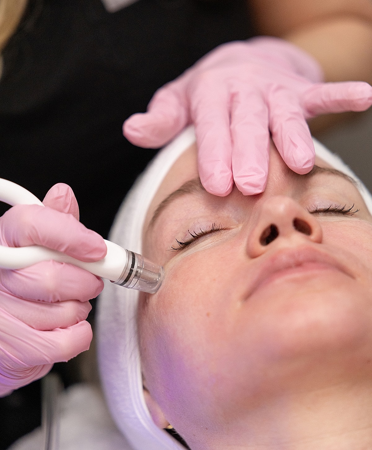 Facial treatment with microneedling device in progress.