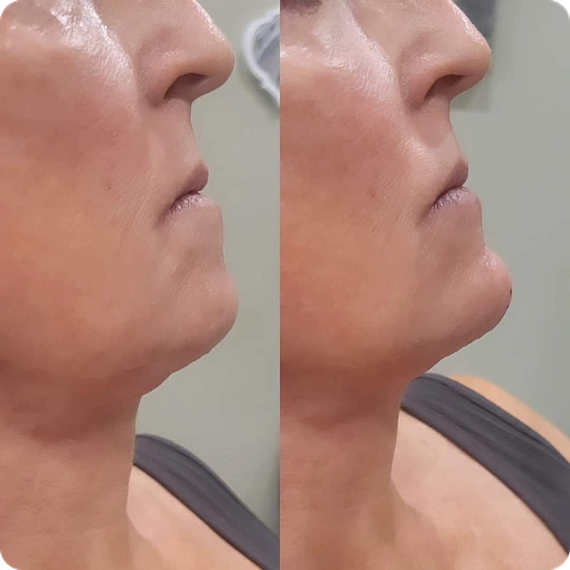Facial Contouring Gallery Before & After